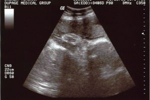 35 Week Ultrasound Today 35 Week Ultrasound Today